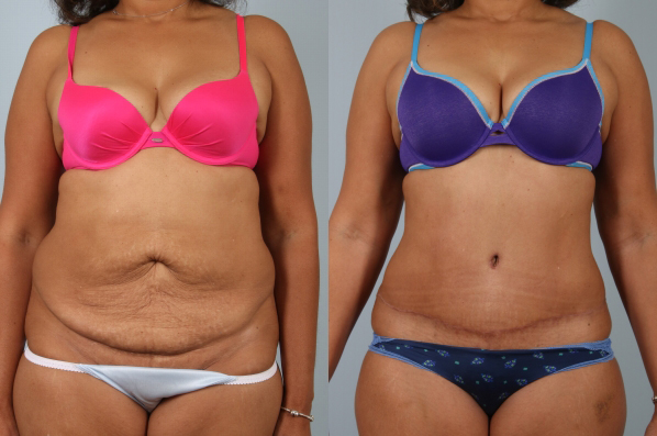 Tummy Tuck before and after - before