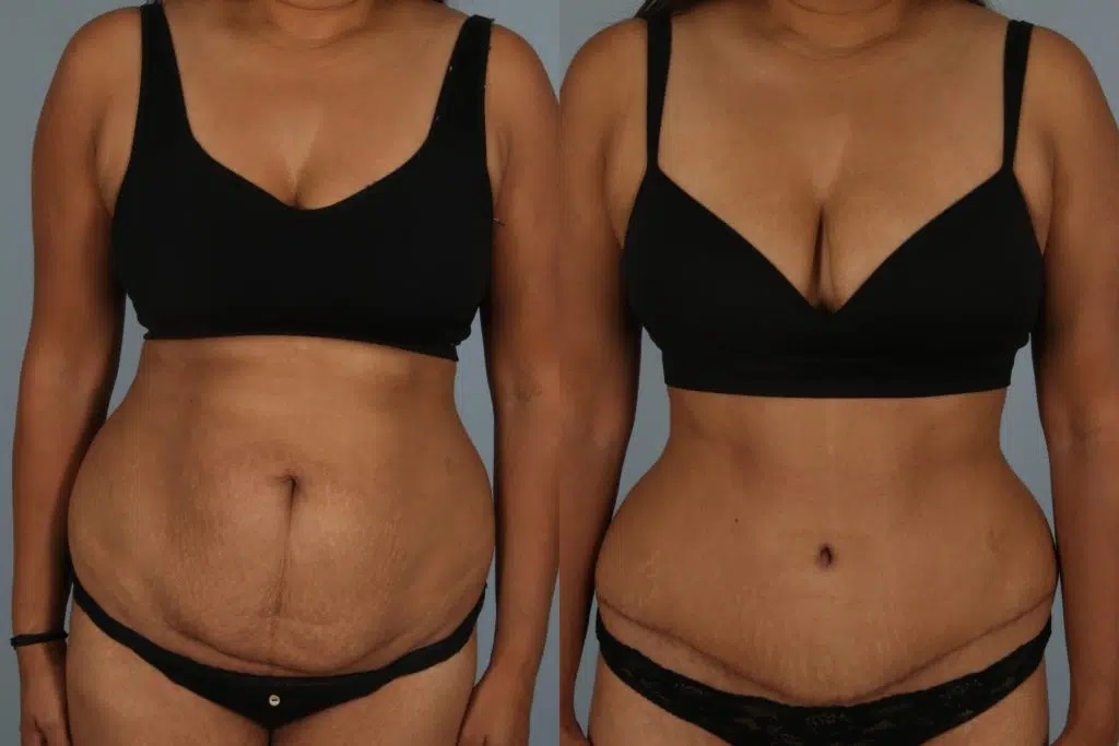 Tummy Tuck before and after - before