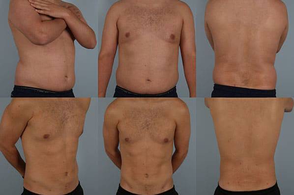 Liposuction before and after - before