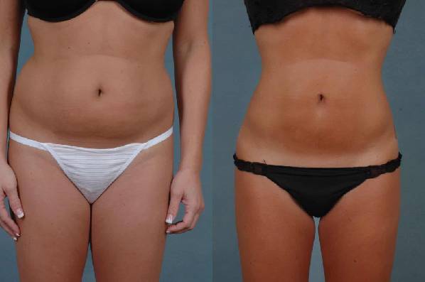 Liposuction before and after - before