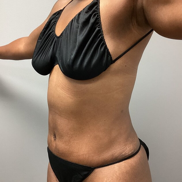 AbEX Stomach before and after - after