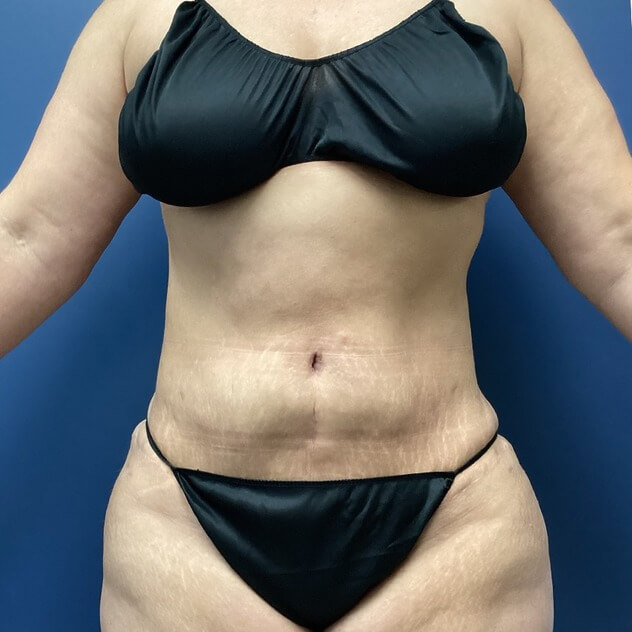 AbEX Stomach and Waist before and after - after