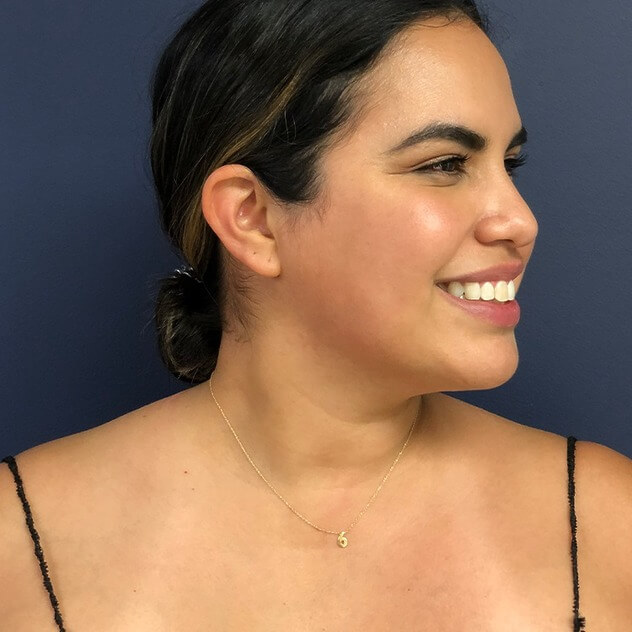 Chin Liposuction before and after - after