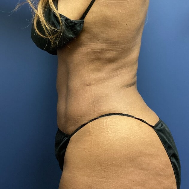 Liposuction Stomach before and after - after