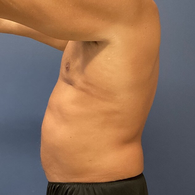 Liposuction before and after - after