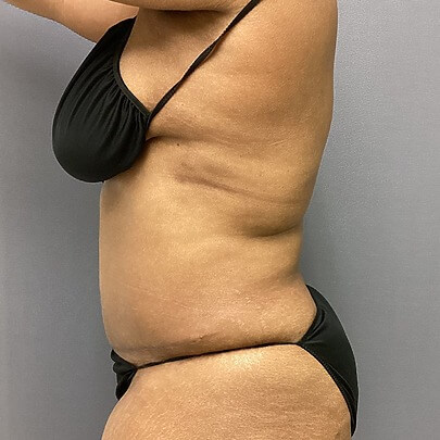 Tummy Tuck before and after - after