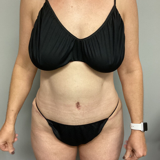 AbEX Stomach before and after - after