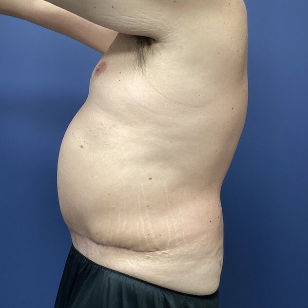 Liposuction before and after - after