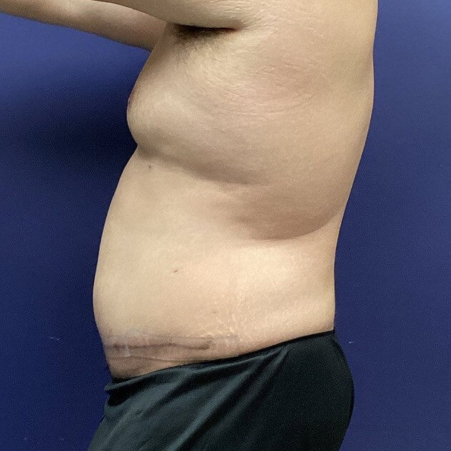 AbEX before and after - after