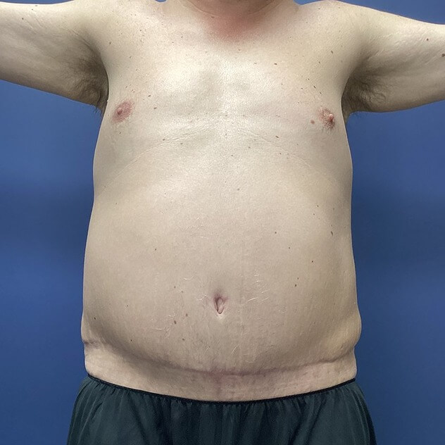 Liposuction before and after - after