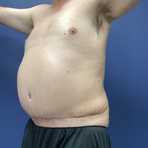 Liposuction before and after - after