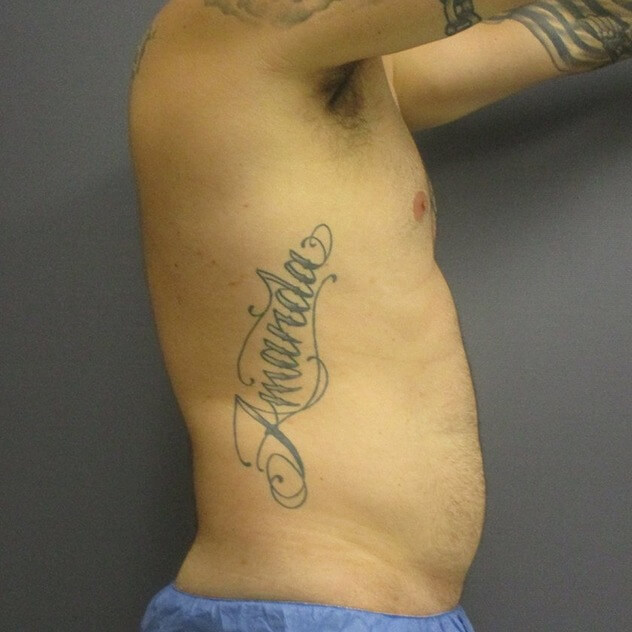 Liposuction before and after - before