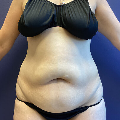 Tummy Tuck before and after - before
