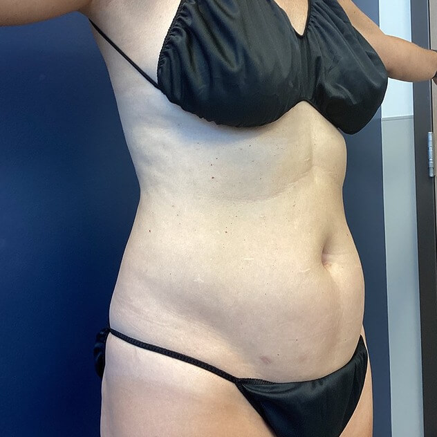 Liposuction Stomach and Waist before and after - before