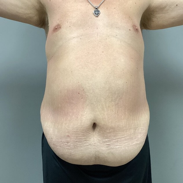 Liposuction before and after - before