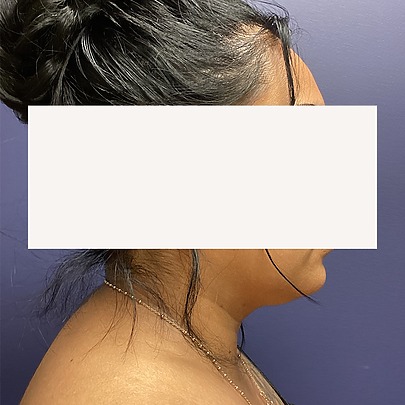 Chin before and after - before