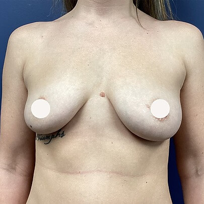 Breast Augmentation before and after - before