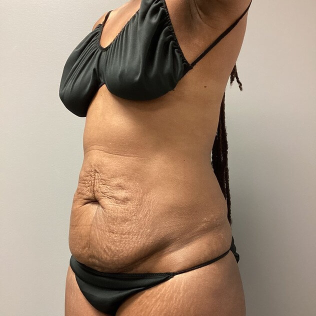 AbEX Stomach before and after - before