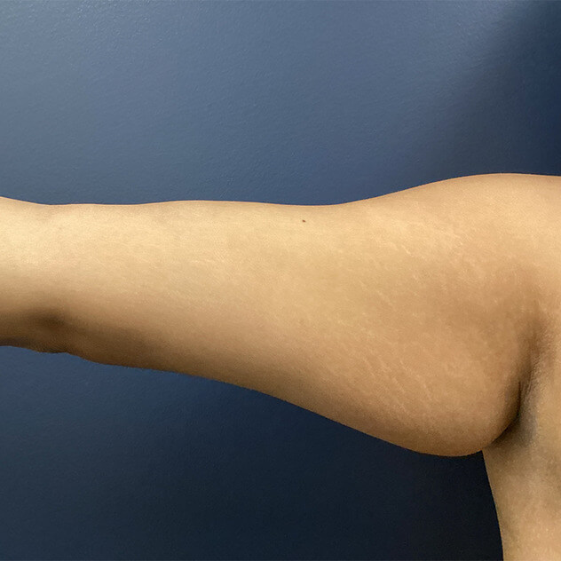 Liposuction Arm before and after - before