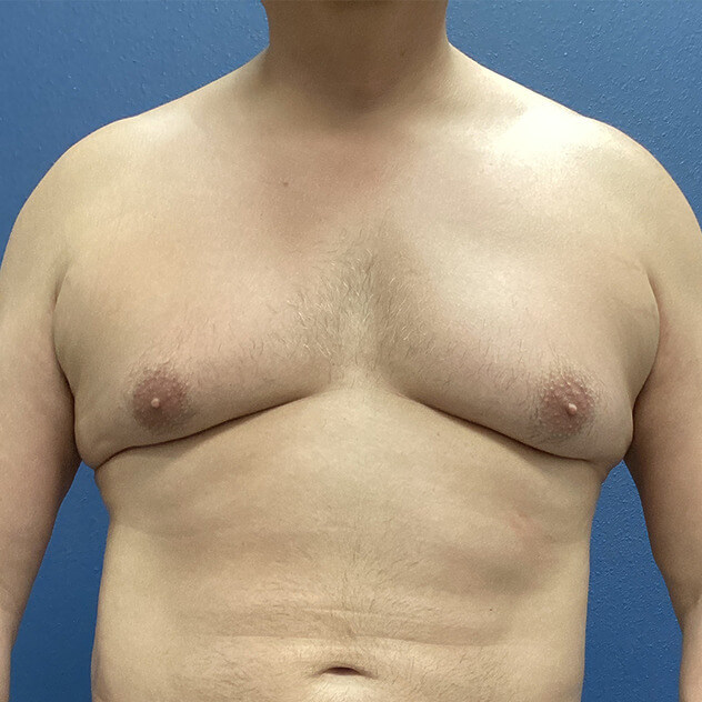ChestEX before and after - before