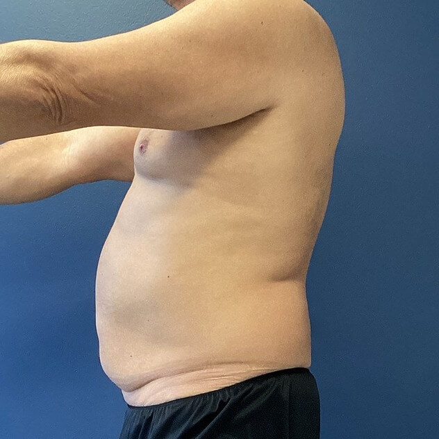Liposuction before and after - before