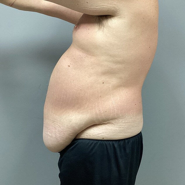 Liposuction before and after - before