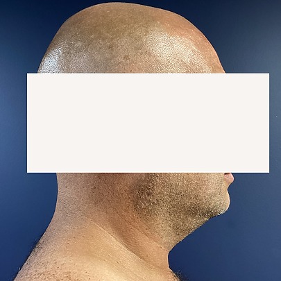 Chin before and after - before