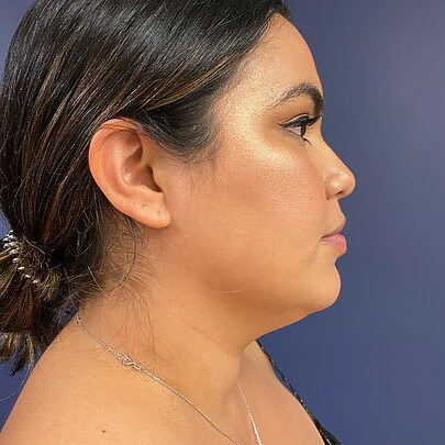 Chin before and after - before