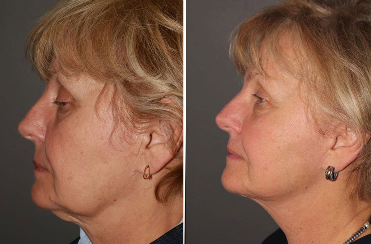Facelift before and after - after