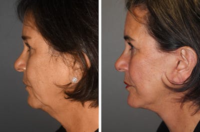 Facelift before and after - after