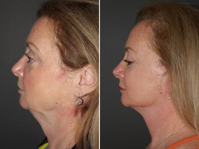 Facelift before and after - after