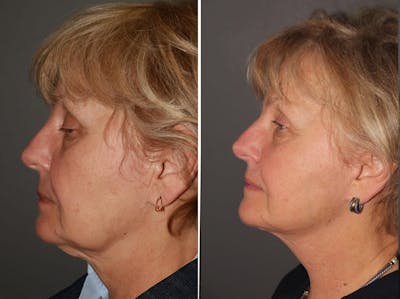 Facelift before and after - before