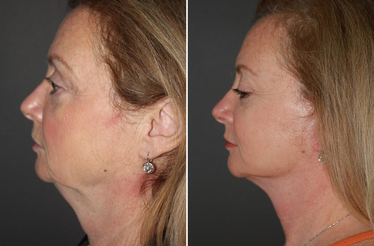 Facelift before and after - before