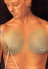 Male Breast Reduction before and after - after