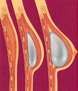 Breast Reconstruction before and after - after