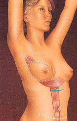 Breast Reconstruction before and after - after