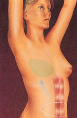 Breast Reconstruction before and after - before
