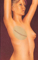 Breast Reconstruction before and after - before