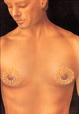 Male Breast Reduction before and after - before