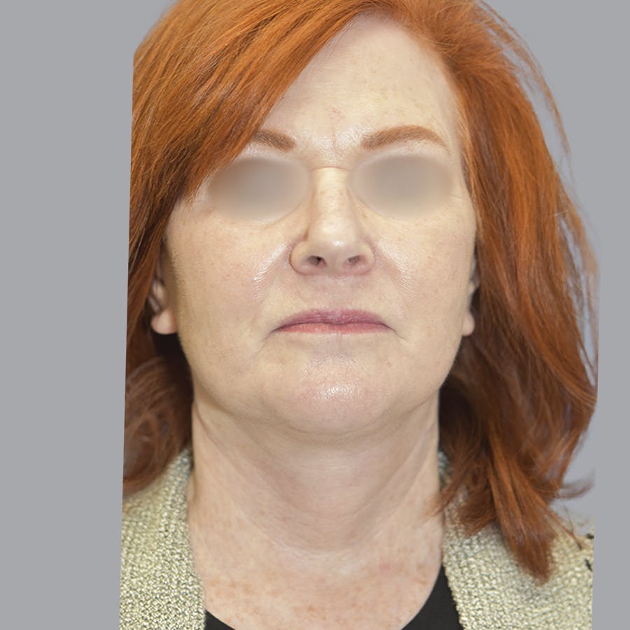 Deep Plane Facelift before and after - after