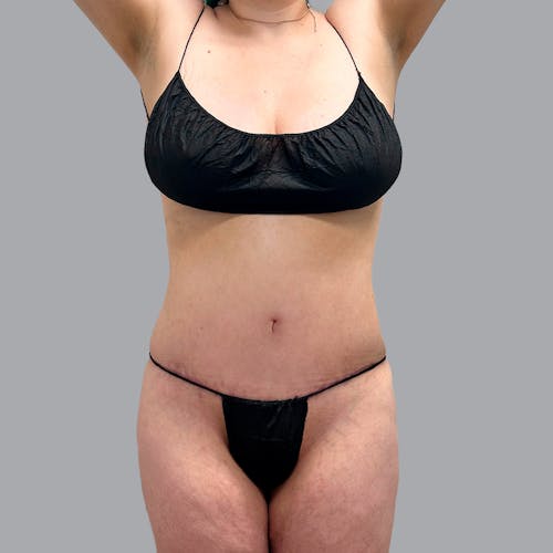 Tummy Tuck before and after - after
