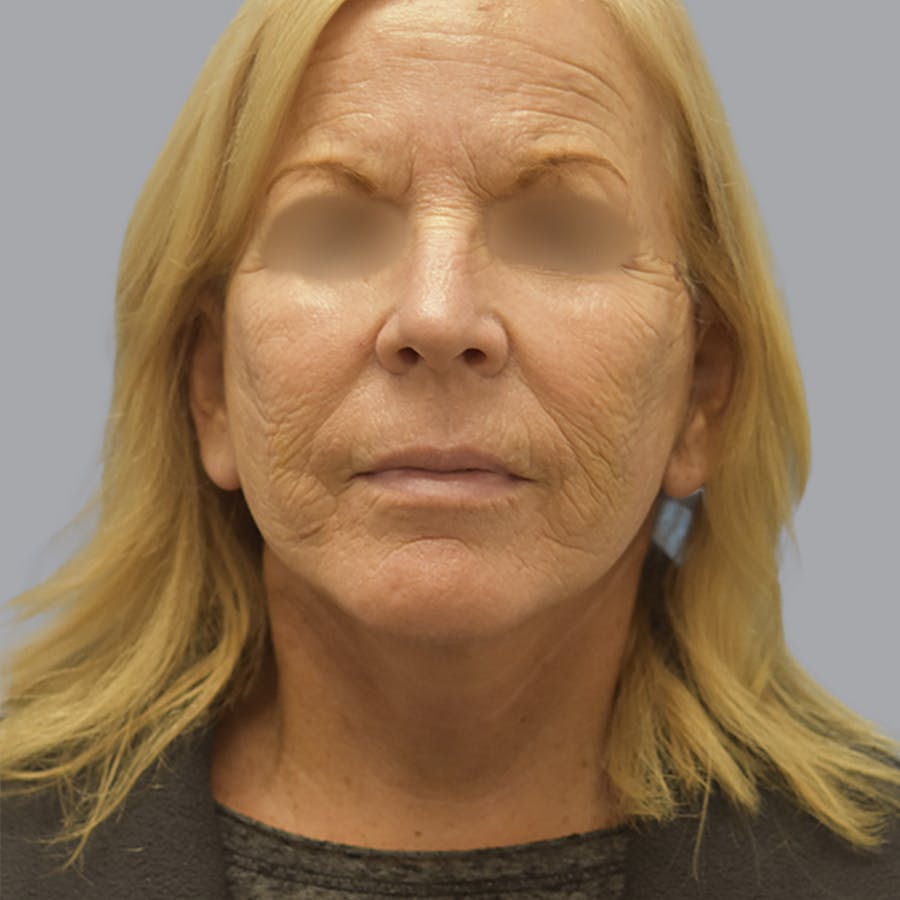 Deep Plane Facelift before and after - after
