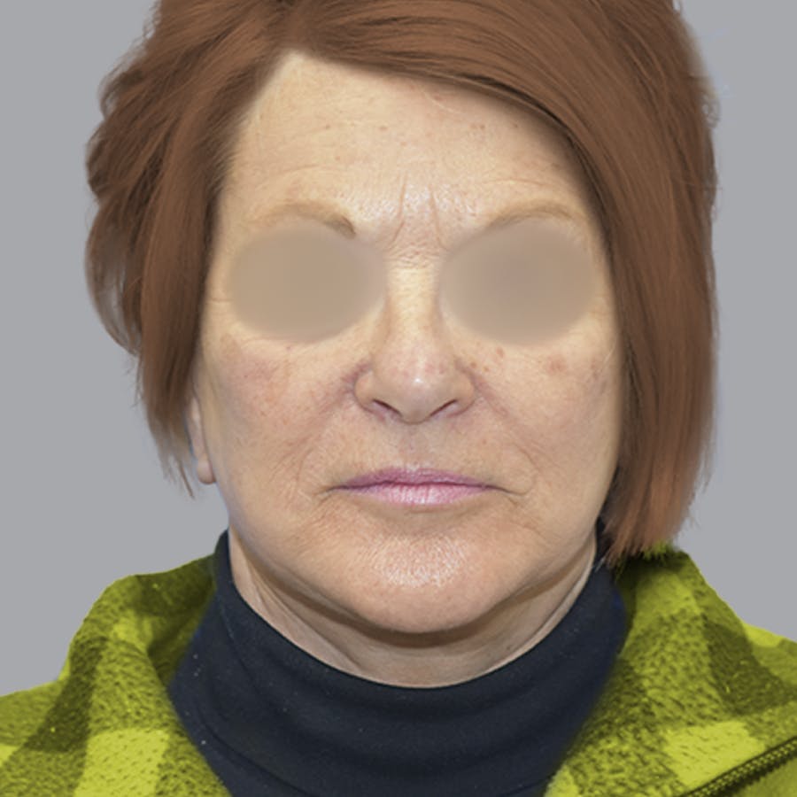 Deep Plane Facelift before and after - after