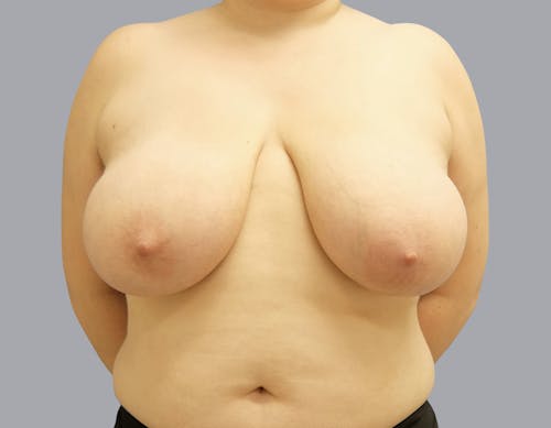 Breast Reduction before and after - before