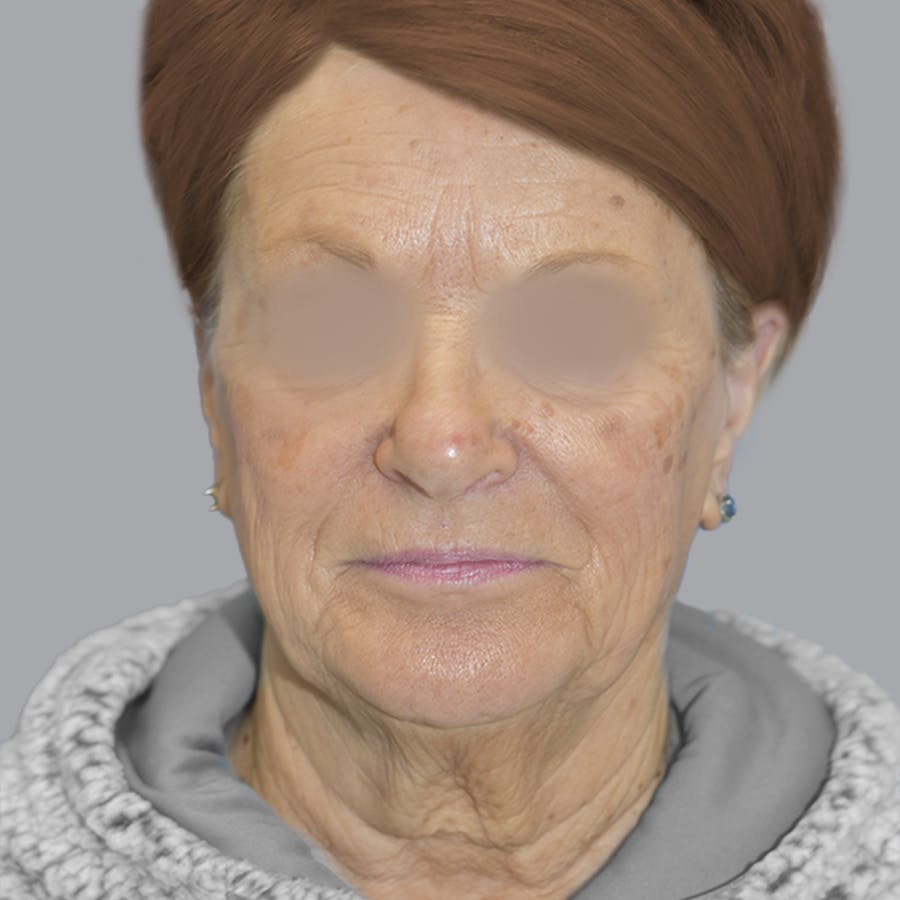 Deep Plane Facelift before and after - before