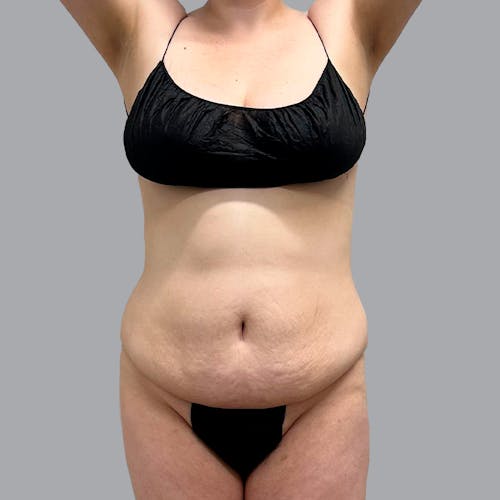 Tummy Tuck before and after - before
