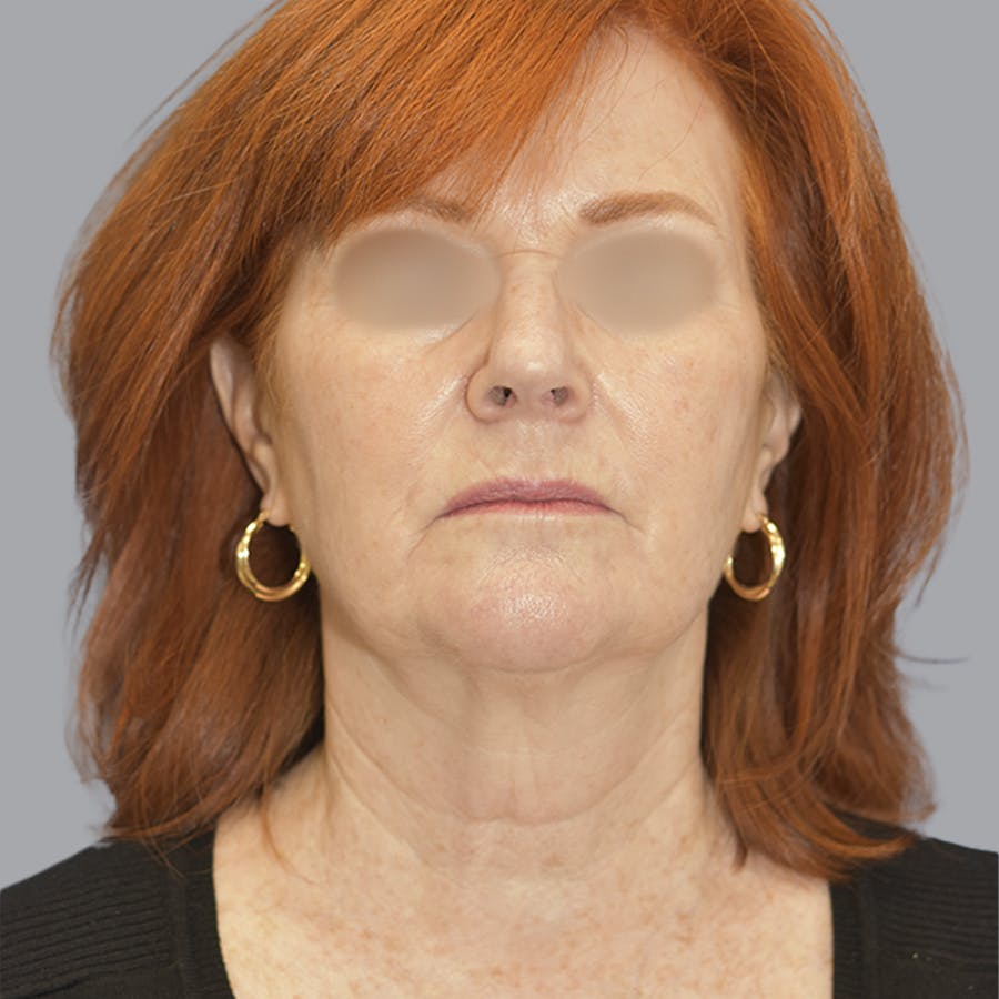 Deep Plane Facelift before and after - before