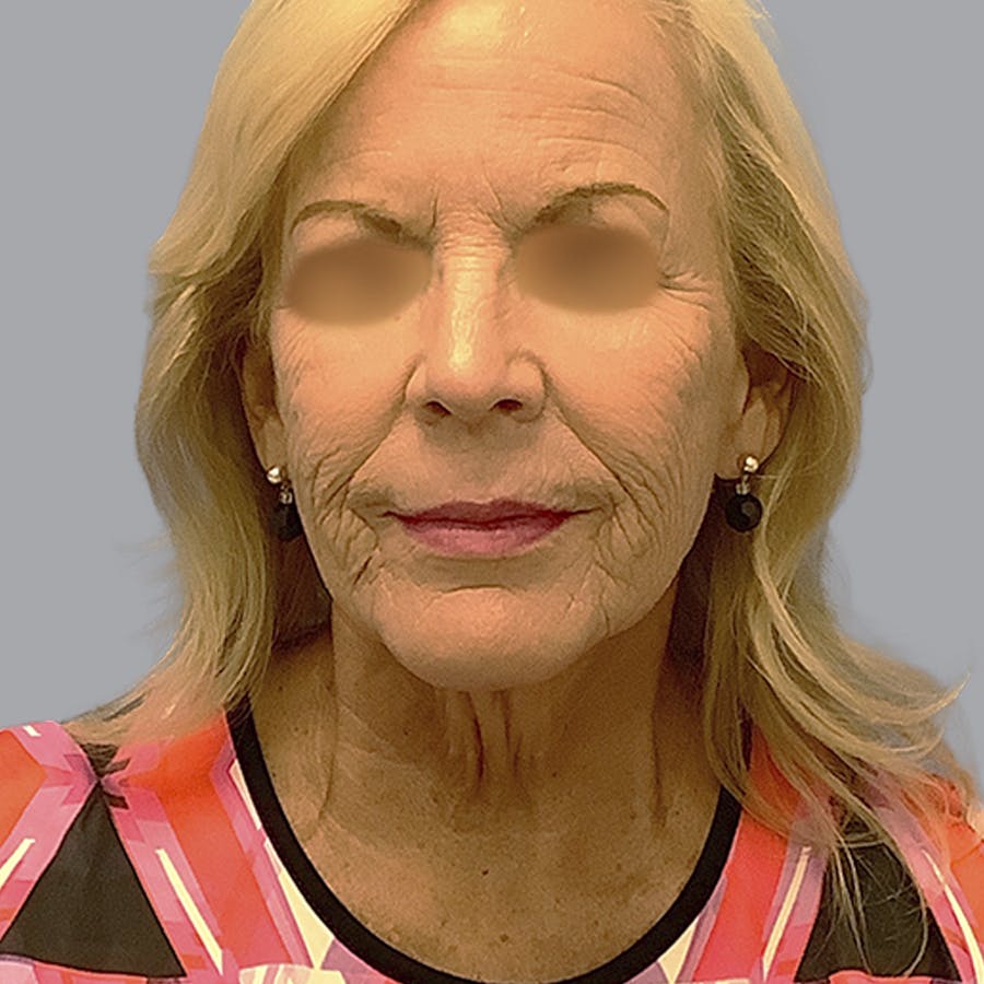 Deep Plane Facelift before and after - before