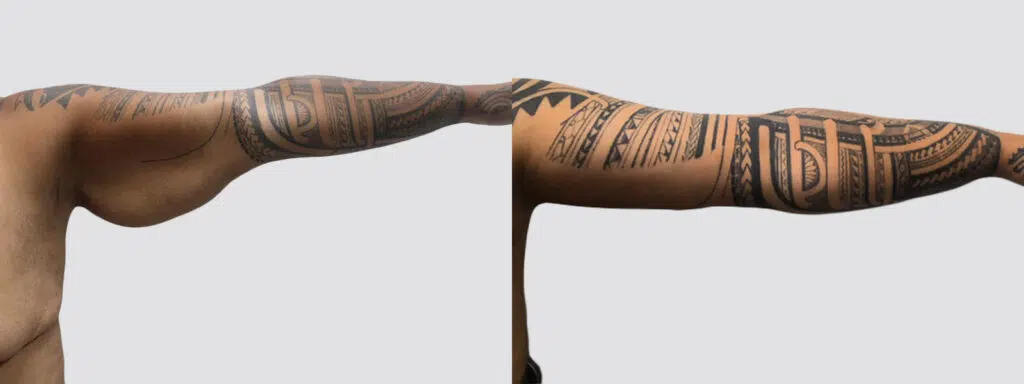 Arm Lift before and after - after