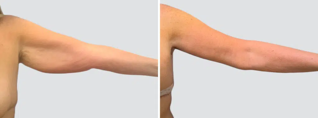 Arm Lift before and after - after
